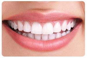 Clareamento | Dentista Uberlândia